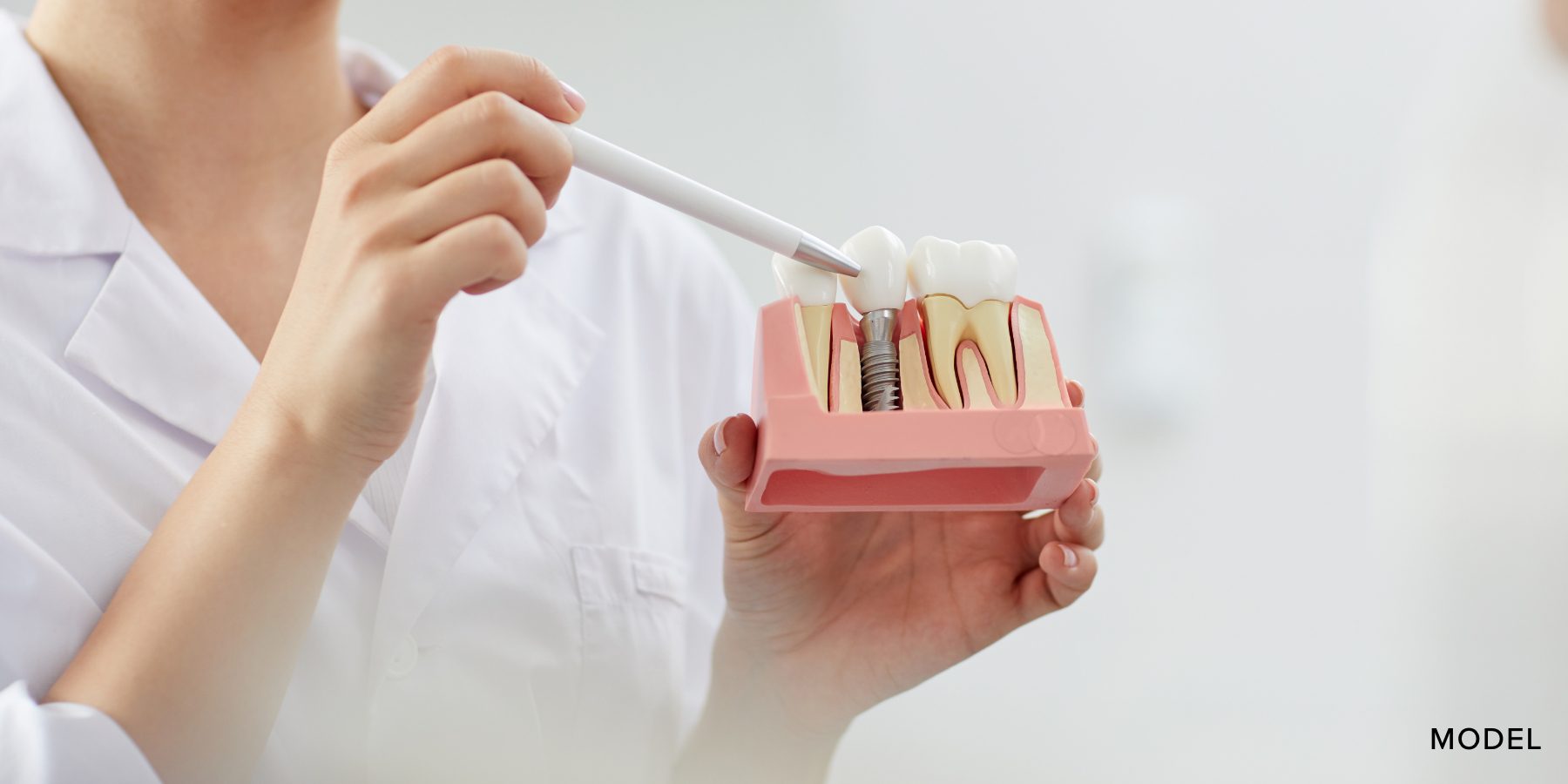 Mioral surgery blog implants dentures | mercer island oral & maxillofacial surgery